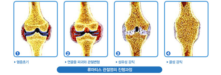 류마티스 관절염의 진행과정 - 1.염증초기 2.연골을 파괴와 관절변형 3.섬유성 강직 4.골성 강직